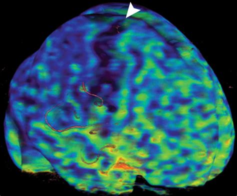 Whole Brain Perfusion Ct Performed With A Prototype 256detector Row Ct