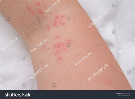 Small Itchy Bumps On Arms Shop Price Save 63 Jlcatjgobmx