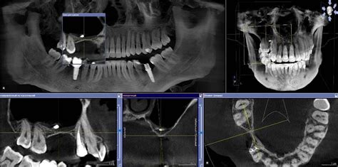 Jaw Fracture Recovery Time How Long Does A Fractured Jaw Take To Heal