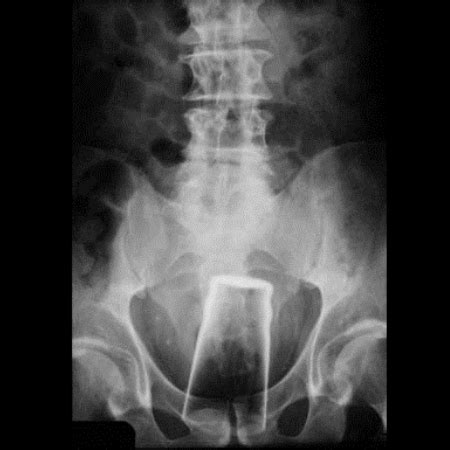Craziest Foreign Objects Found Stuck In A Rectum Found Objects Oddee