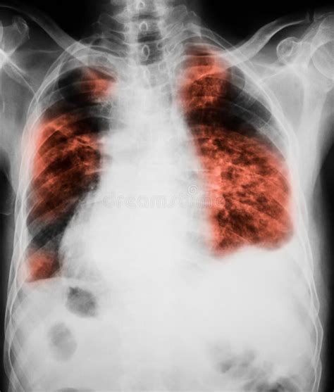 Chest X Ray Image Showing Lungs Infection Stock Photo Image Of