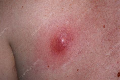 Infected Sebaceous Cyst Stock Image M1300702 Science