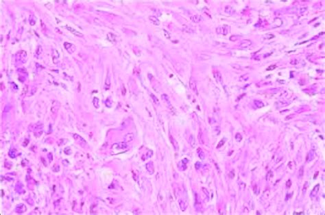 Uterine Smooth Muscle Tumor With Mild Mitotic Activity Smooth Muscle