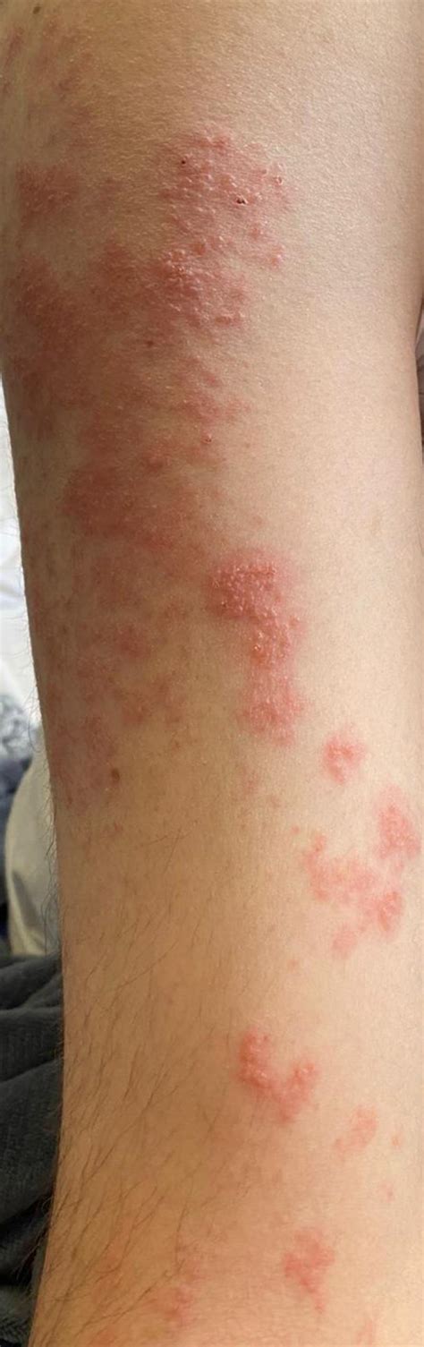 Does This Look Like Shingles If So How Severe Rshingles