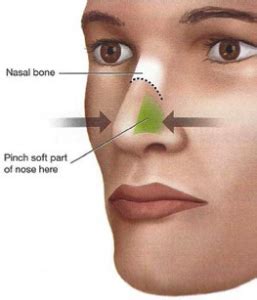 Bleeding most commonly occurs in one nostril only. Nosebleeds 101 | The Sinus and Allergy Center