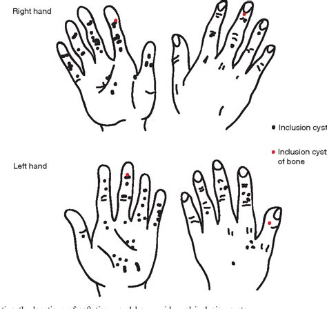 Epidermoid Cysts In The Hand Semantic Scholar