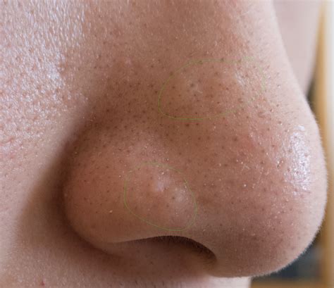 Flesh Colored Bump On Nose
