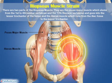 Iliopsoas Muscle Straincausessignssymptomstreatmentdiagnosis