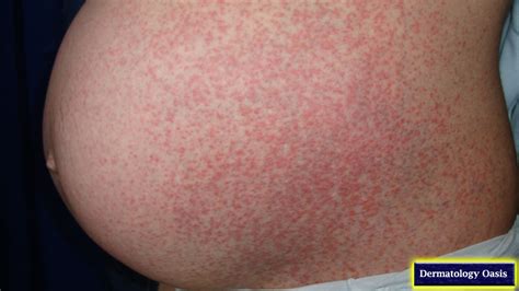 Pruritic Urticarial Papules And Plaques Of Pregnancy Puppp