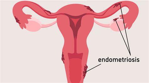 Learn All About Endometriosis In This Minute To Understanding From The