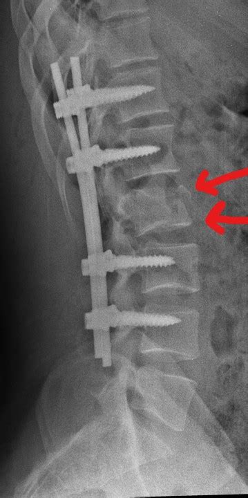 Sex After Spine Surgery