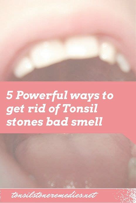 How To Remove Tonsil Stones Smell Howtoermov