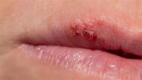 Common Diseases That Cause Rashes On The Lips A Comprehensive Guide