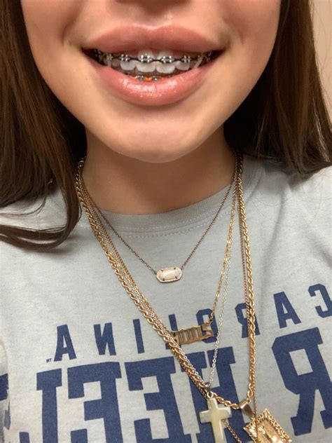 Pin By Badbiddiesonly🕸️ On Braces In 2022 Braces Colors Braces Tips