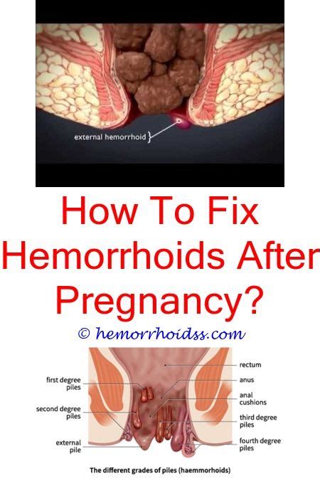 When Should I See A Doctor For Rectal Hemorrhoids