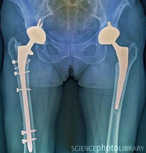Double Hip Replacement Post Op X Ray Avascular Necrosis Avascular