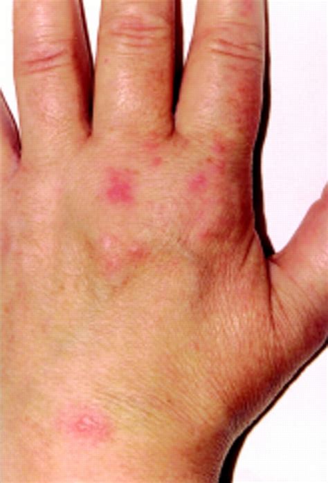 A Case Of Shingles Mimicking Carpal Tunnel Syndrome Annals Of The
