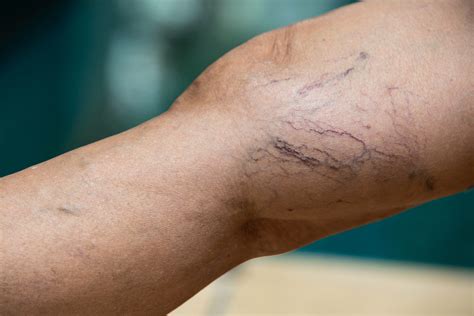 Understanding The Types Of Varicose Vein Treatments Spider And