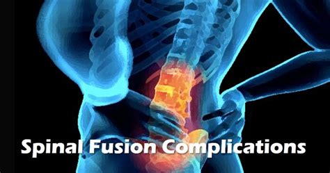 Long Term Side Effects Of Spinal Fusion Centeno Schultz