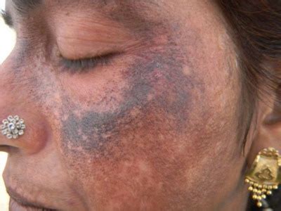 Maybe you would like to learn more about one of these? Exogenous ochronosis following self medication of topical ...