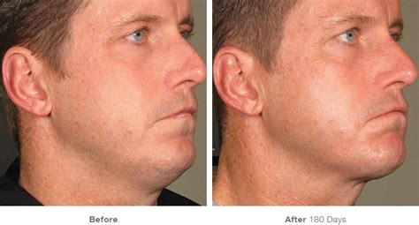 Plastic Surgery For Acne Scars Before And After