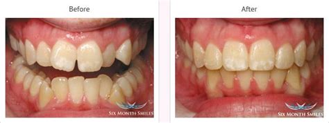 Six Month Smiles Kent Gravesend 6 Month Smiles Cost And Reviews