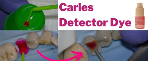 Is Caries Detector Dye Bs Pdp138 Protrusive Dental Podcast