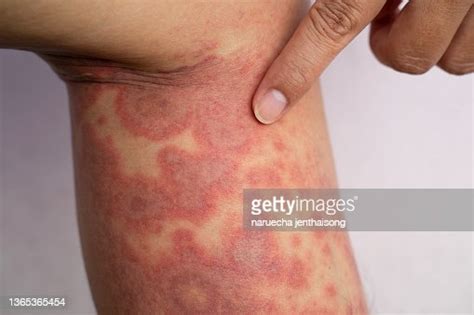 Acute Atopic Dermatitis On The Legs A Red Inflamed Scaly Rash On The