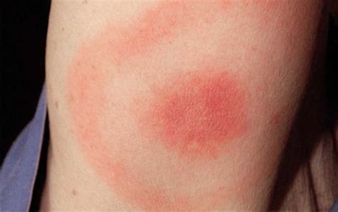 Erythema Migrans Causes Symptoms Diagnosis And Treatment