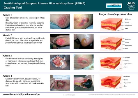 Ulcer Classification Scottish Adapted European Pressure Ulcer Advisory Panel Epuap Skin