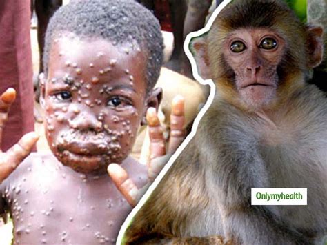 Recent examples on the web the wildlife trade contributed to the spread of the h5n1 virus, monkeypox and other diseases, according to a 2007 study in the. monkeypox virus in Singapore symptoms and treatment guidelines