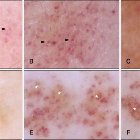 Main Dermoscopic Features In Pigmented Purpuric Dermatosis And Fleiss