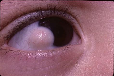 Eyeball Bubble Types Symptoms And Medical Care