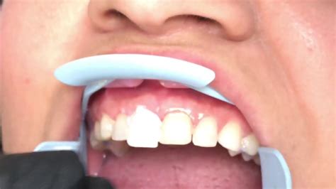 Houston Cosmetic Dentistlumineers Smile Transformation And