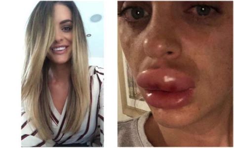 Womans Botched Lip Filler Procedure Becomes A Prolonged Nightmare