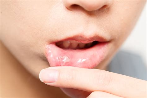 Some of our bad habits cause most of the time ulcers with our oral health. What to Do About That Mouth Ulcer | Cirocco Dental Center