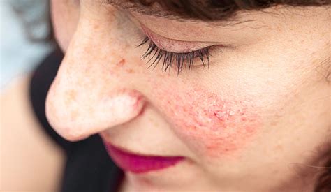Everything You Need To Know About Redness From Causes To Treatments