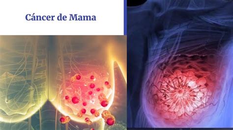 Cáncer De Mama Anatomía Básica Concepto Clasificación Detección