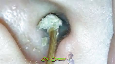 Huge Ear Wax Removal Compilation Massive Earwax Removal From 5 People
