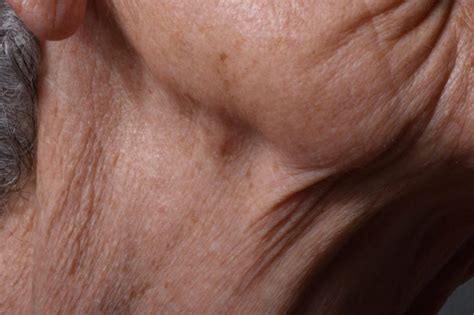 What Bumps On Your Neck Really Mean The Healthy