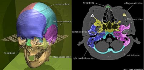Skull, vertebral column and sacrum) and. Voxel-Man 3D-Navigator: Brain and Skull