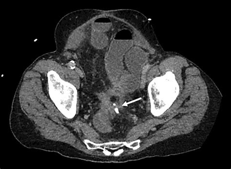 Ct Scan Of The Abdomen And Pelvis With An Arrow Pointing To Surgical