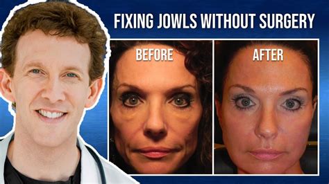 Can Jowls Be Fixed Without Surgery Youtube