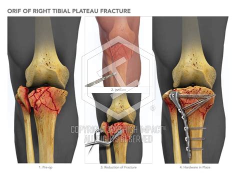 Orif Of Tibial Plateau Fracture High Impact® Visual Litigation