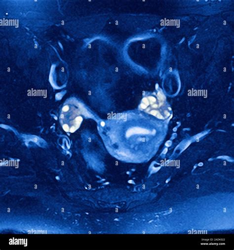 Polycystic Ovaries Magnetic Resonance Imaging Mri Scan Of A Female