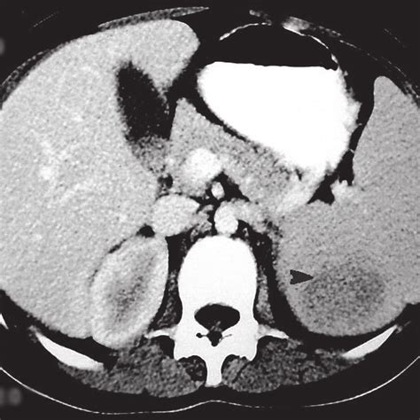 Contrast Enhanced Abdominal Computed Tomography Scan Demonstrating A