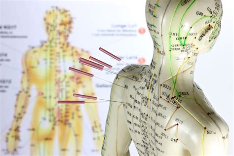 what you need to know about acupuncture life hacks