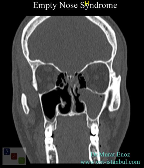 Cool Small Dry Turbinate Empty Nose Syndrome