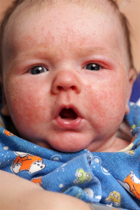 Baby Eczema Treatment On The Nhs A Parents Guide