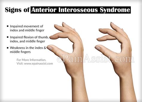 Anterior Interosseous Syndrome Signs Treatment Causes Diagnosis
